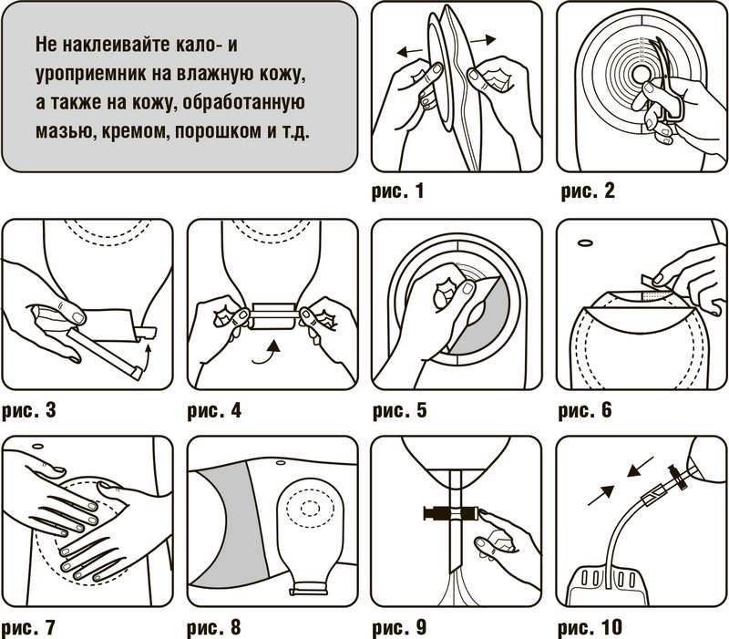Калоприемники для стомы - виды, алгоритм замены, советы по уходу